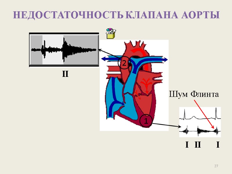 27 НЕДОСТАТОЧНОСТЬ КЛАПАНА АОРТЫ II 2